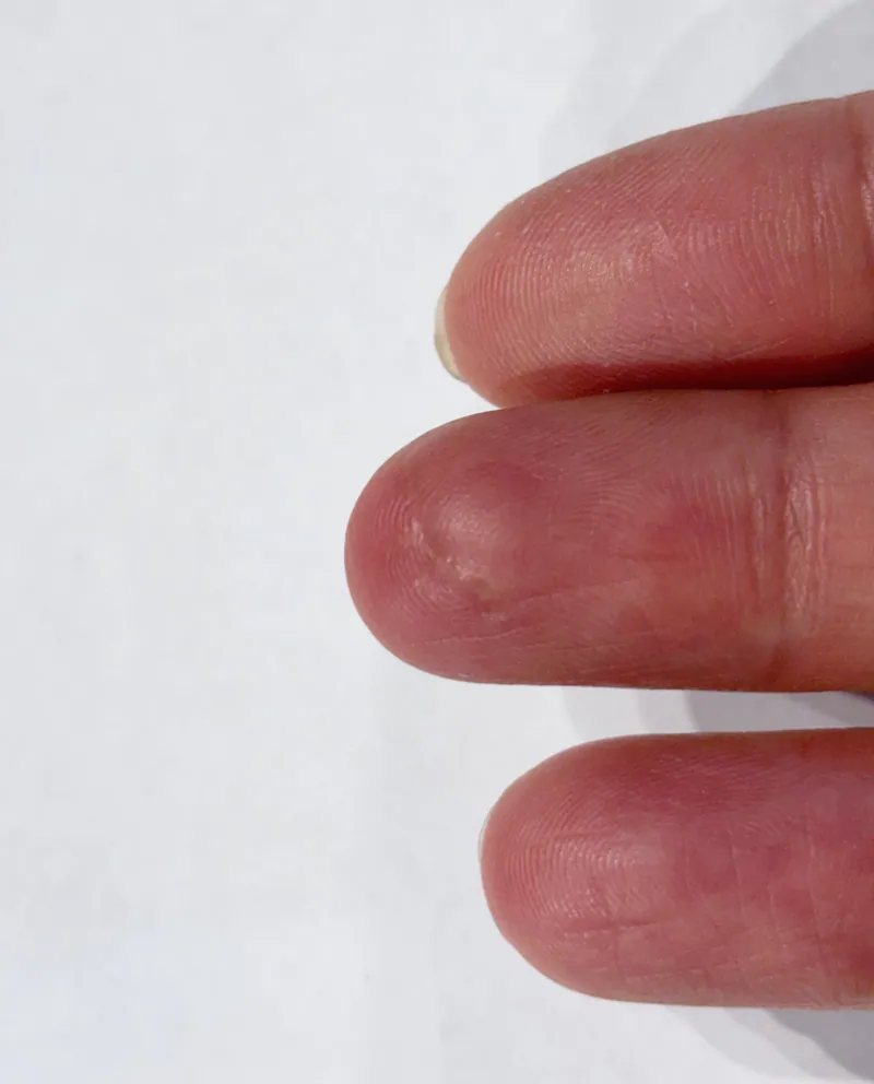 After finger suture repair — healed in two weeks