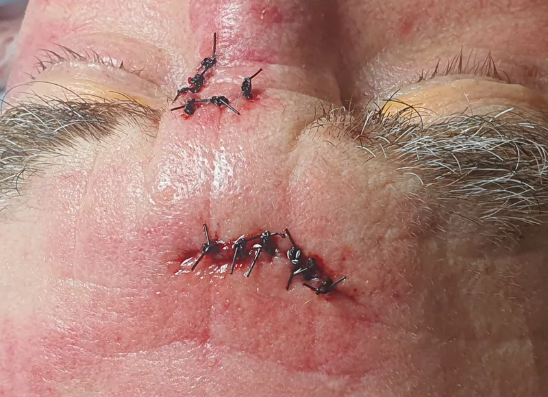 Forehead and nose sutures — continued healing