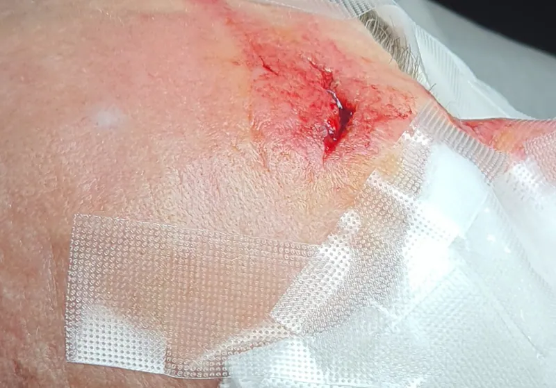 Immediately after forehead and nose suture repair