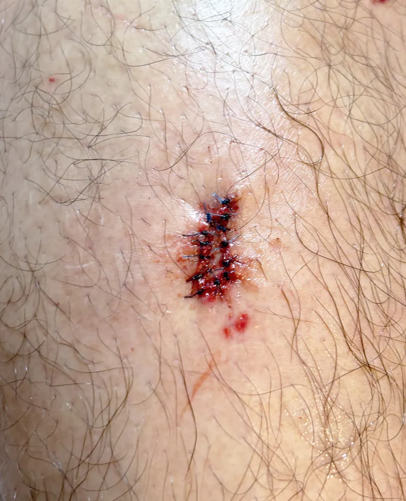 After suture repair on leg — healed