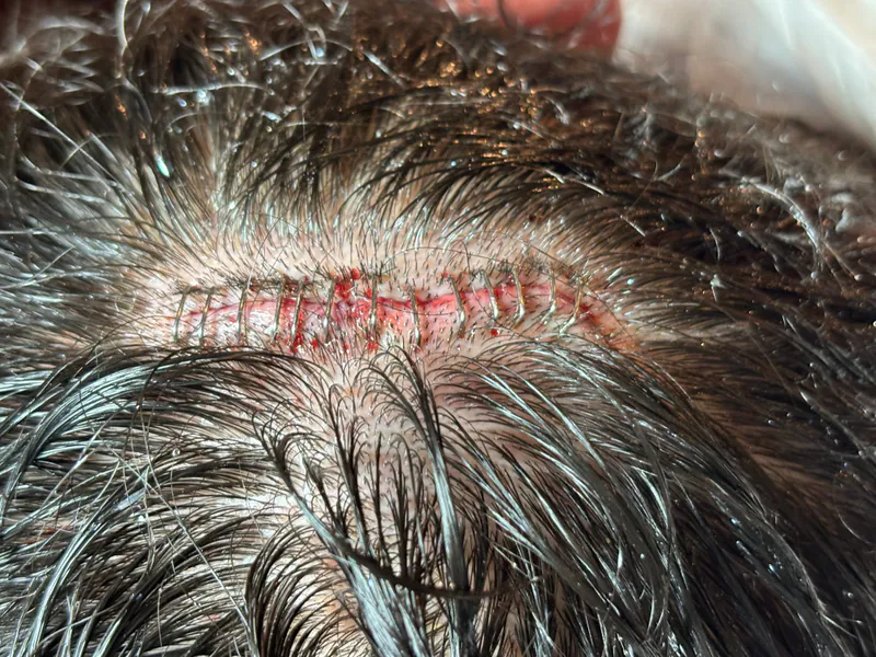 After staple closure on scalp — healed
