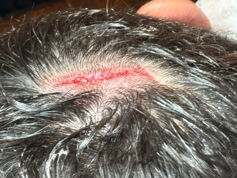 Before staple closure on scalp