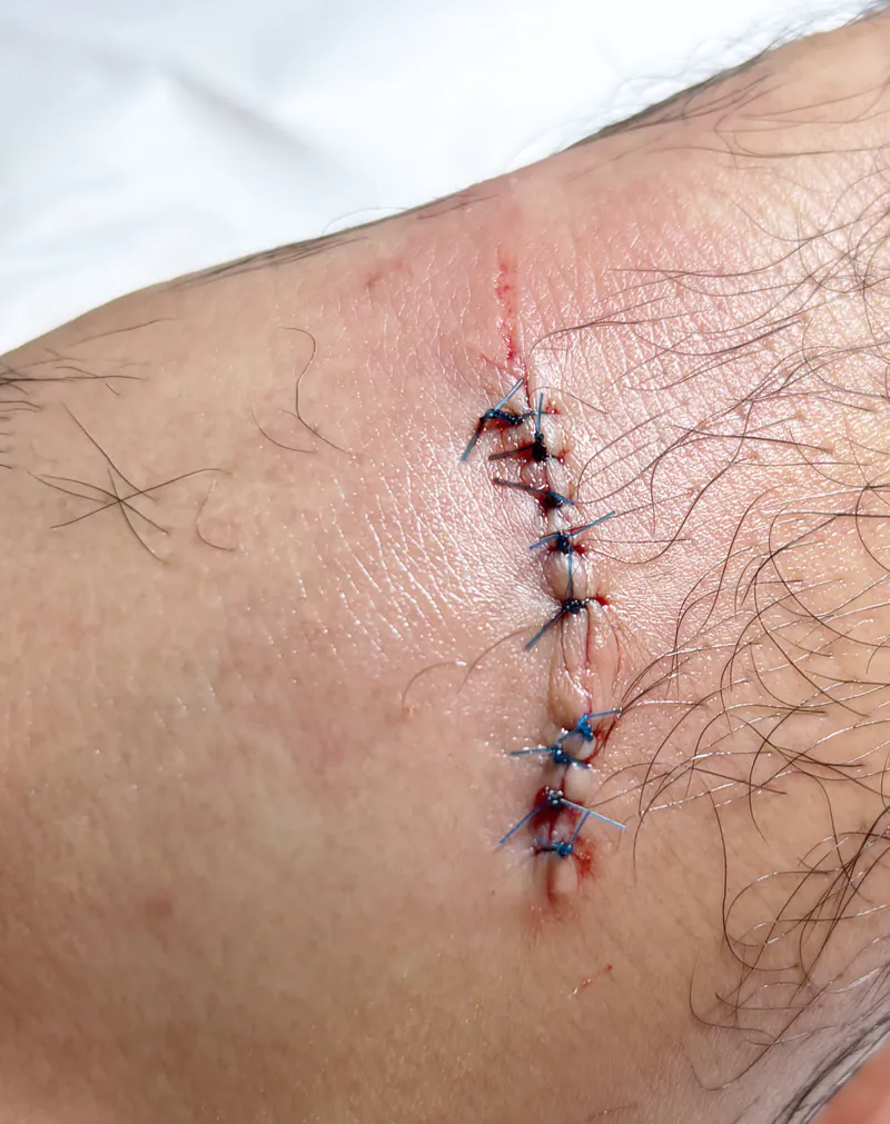 After suture repair on arm — healed