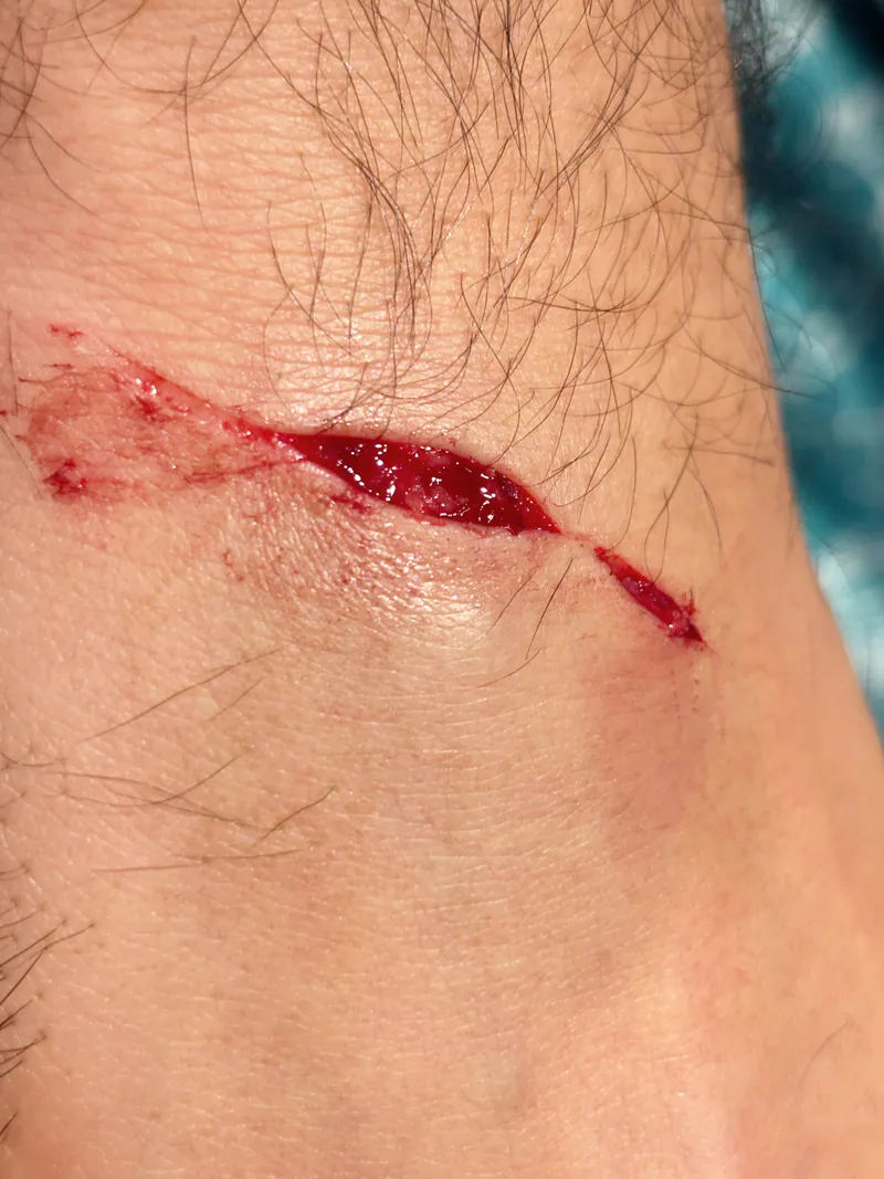 Before suture repair on arm
