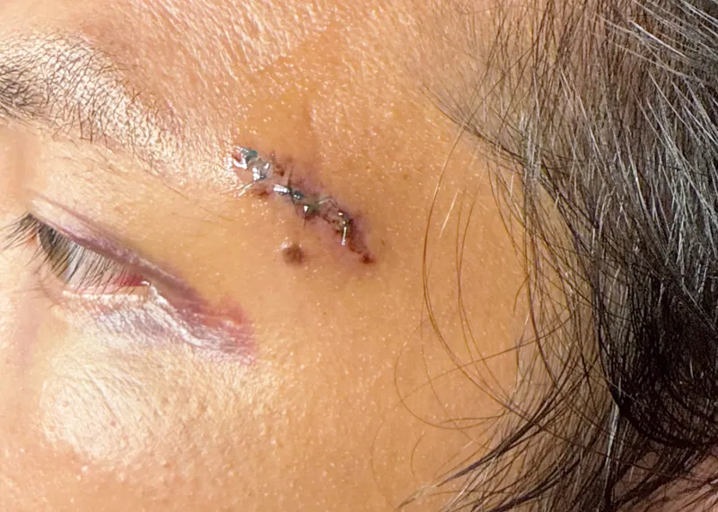 Temple suture repair healing after three days