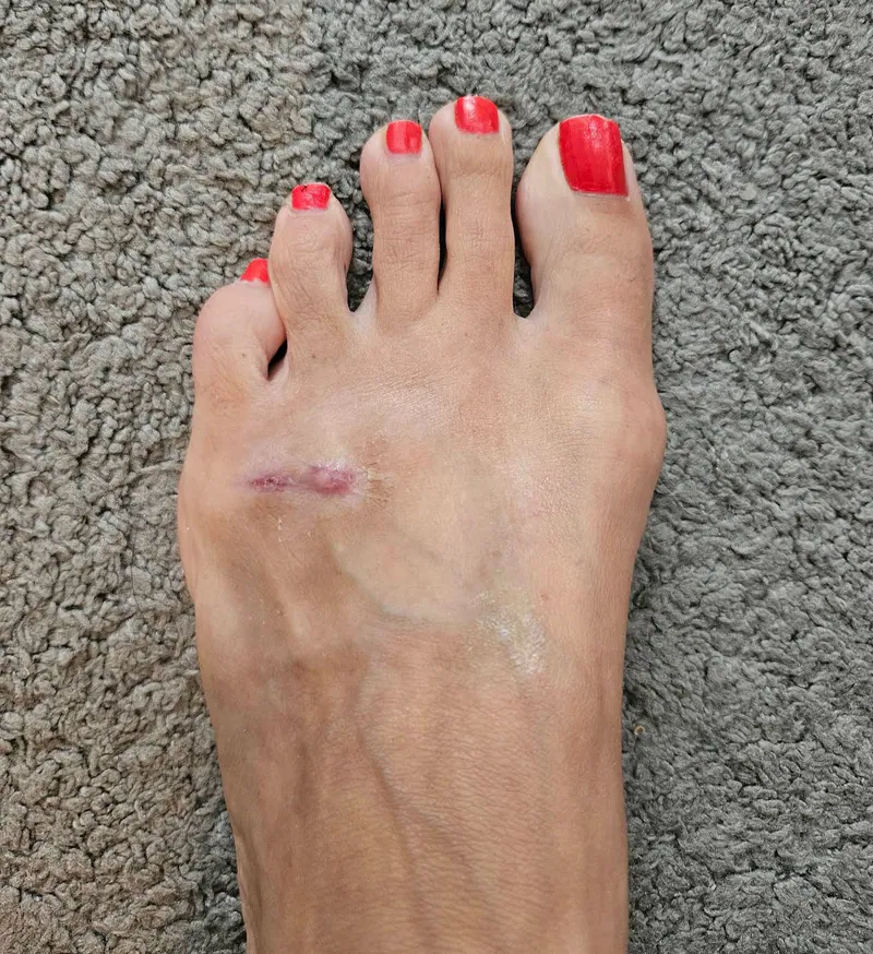 After wound care treatment on foot — healed