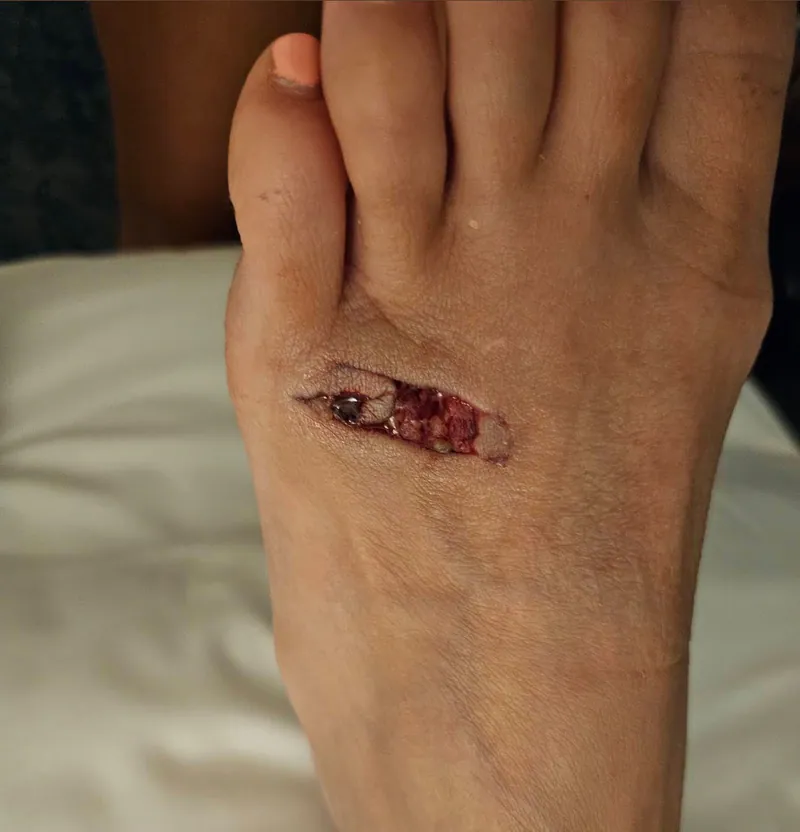 Before wound care treatment on foot